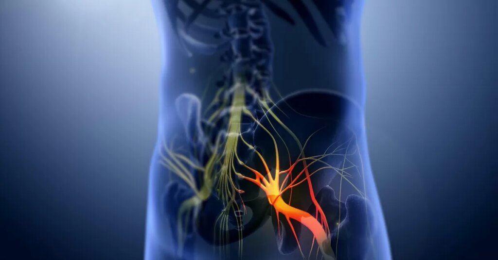 5-remedii-naturale-pentru-a-alina-nevralgia-sciatica.jpg